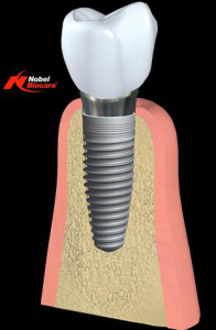 implant